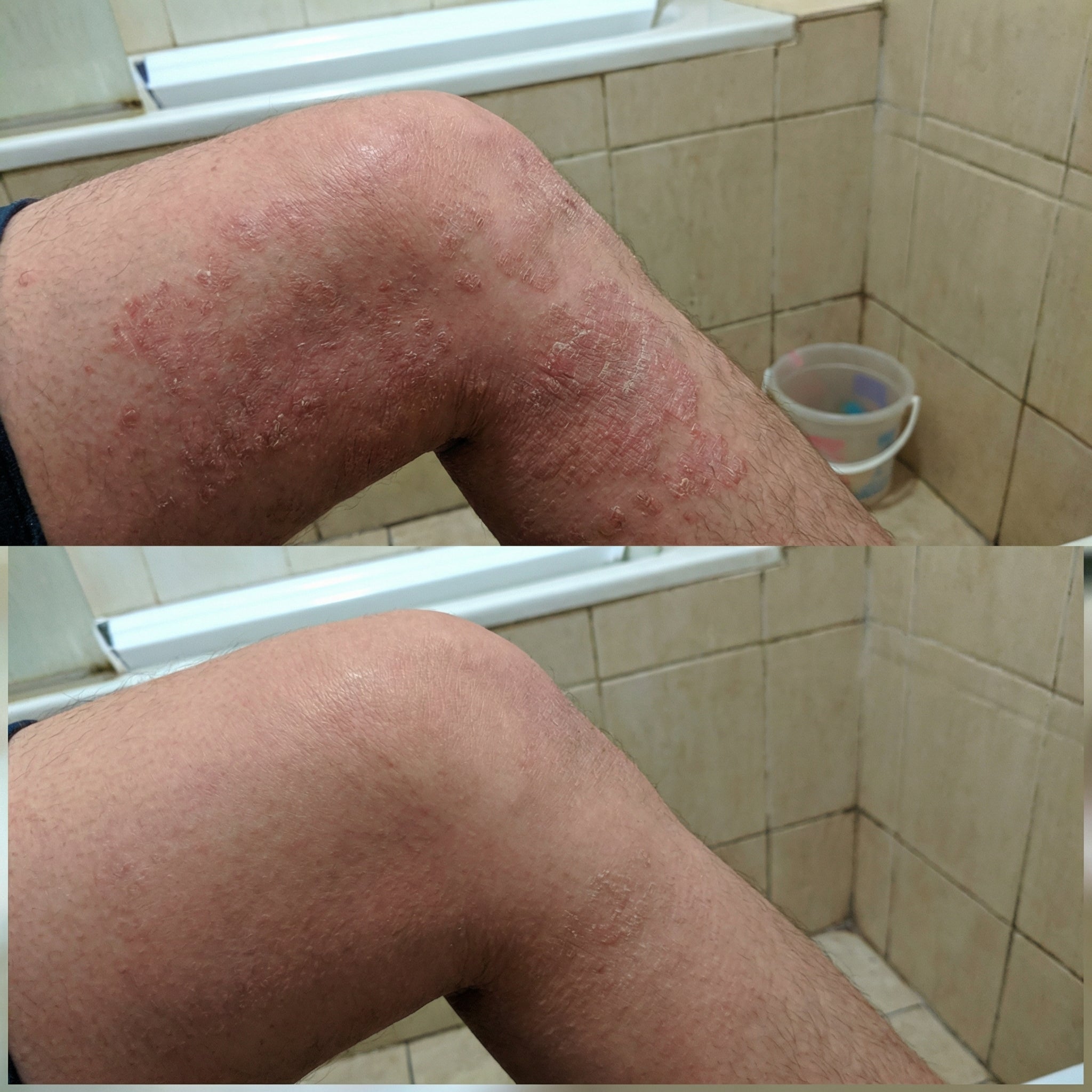 VedicDerm Sensitive Skin Bundle for Psoriasis, Eczema, Atopic Dermatitis - Distacart