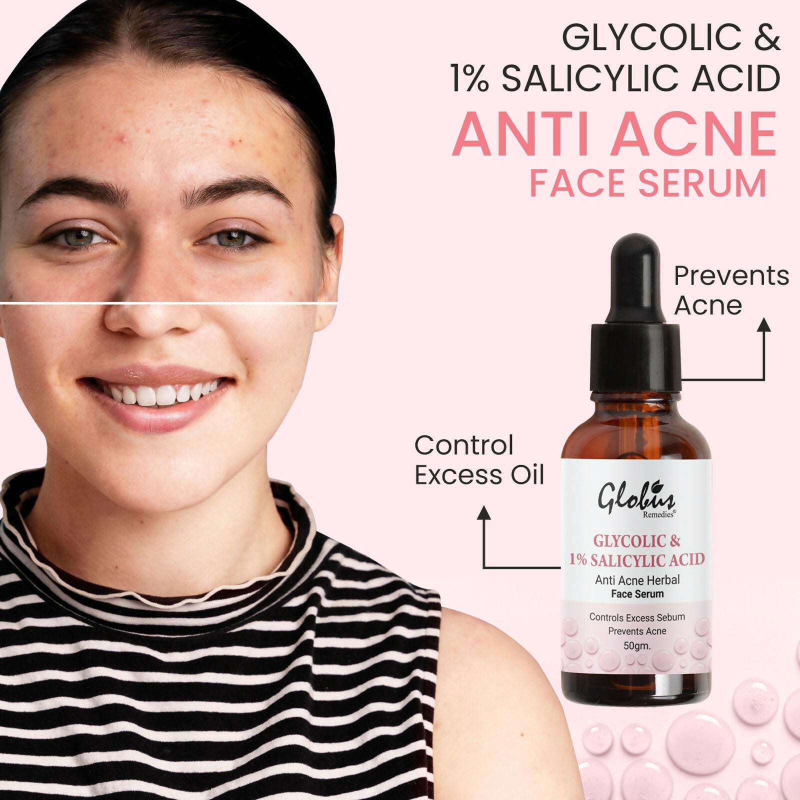 Globus Remedies Glycolic & 1% Salicylic Acid Anti Acne Face Serum
