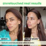 Thumbnail for PLIX The Plant Fix Jamun Active Acne Kit With Spf 50+ Sunscreen & Juicy Cleanser - Distacart