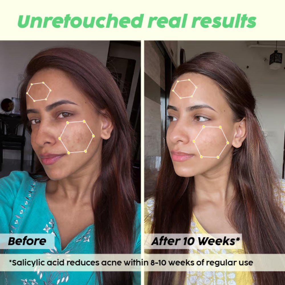PLIX The Plant Fix 0.1% Salicylic Acid Mattifying Sunscreen SPF50+ PA+++ & Niacinamde Serum - Distacart