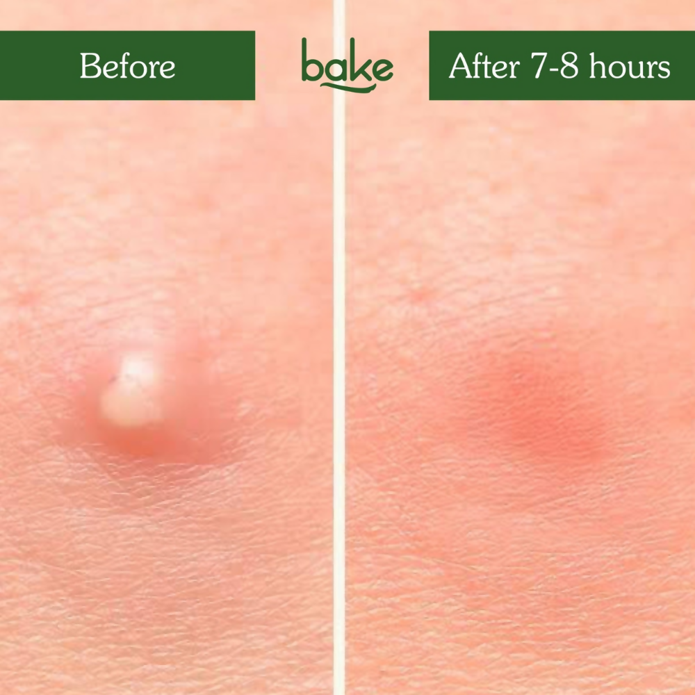 Bake Zit Erase Micro point Patches for Active Acne & Breakouts - Distacart