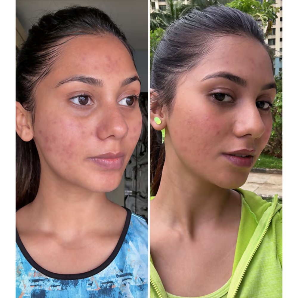 PLIX The Plant Fix 2% Acne Buster Moisturizer & 10% Niacinamide Serum - Distacart