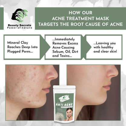 Beauty Secrets Anti Acne Face Mask - Distacart