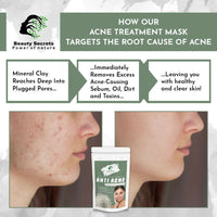 Thumbnail for Beauty Secrets Anti Acne Face Mask - Distacart