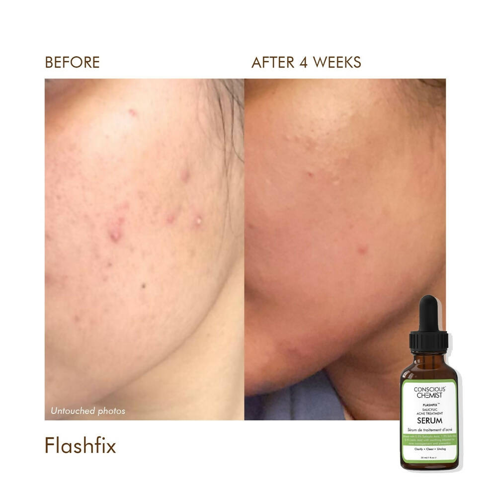 Conscious Chemist Flashfix Salicylic Acne Serum - Distacart