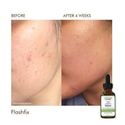 Conscious Chemist Flashfix Salicylic Acne Serum - Distacart